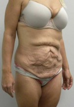 Tummy tuck (Abdominoplasty)