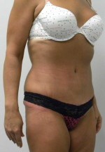 Tummy tuck (Abdominoplasty)