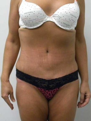 Tummy tuck (Abdominoplasty)