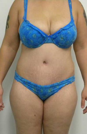 Tummy tuck (Abdominoplasty)