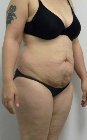 Tummy tuck (Abdominoplasty)