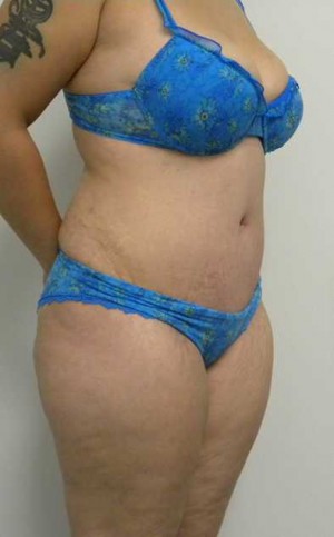 Tummy tuck (Abdominoplasty)