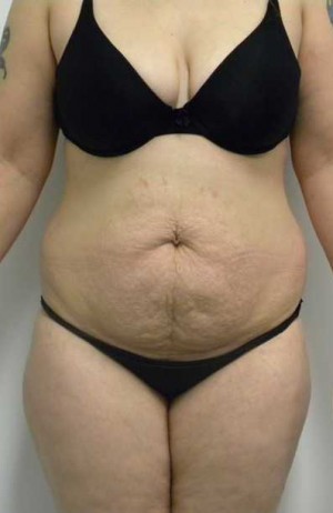 Tummy tuck (Abdominoplasty)