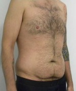 Tummy tuck (Abdominoplasty)