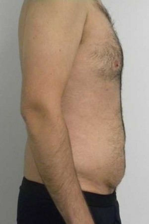 Tummy tuck (Abdominoplasty)