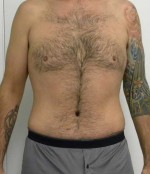 Tummy tuck (Abdominoplasty)