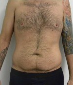 Tummy tuck (Abdominoplasty)