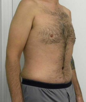 Tummy tuck (Abdominoplasty) Case 4102 After Photo Tummy tuck (Abdominoplasty)