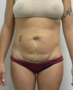 Tummy tuck (Abdominoplasty)