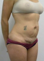 Tummy tuck (Abdominoplasty)