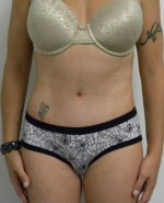 Tummy tuck (Abdominoplasty)