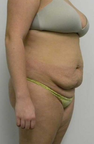 Tummy tuck (Abdominoplasty) Case 4116 Before Photo Tummy tuck (Abdominoplasty)