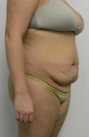 Tummy tuck (Abdominoplasty)