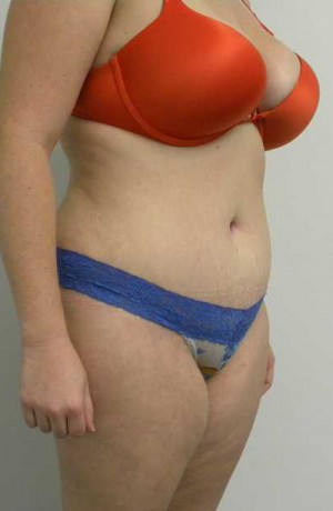 Tummy tuck (Abdominoplasty)