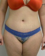 Tummy tuck (Abdominoplasty)
