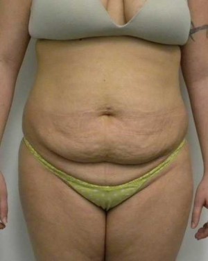 Tummy tuck (Abdominoplasty)