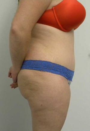 Tummy tuck (Abdominoplasty)