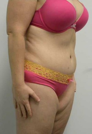 Tummy tuck (Abdominoplasty)