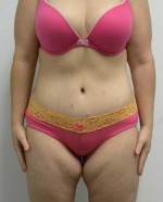 Tummy tuck (Abdominoplasty)