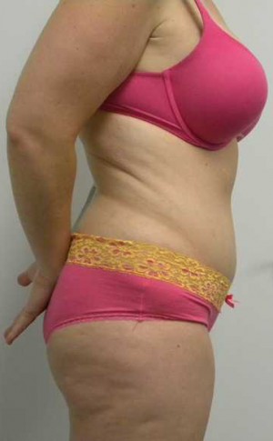 Tummy tuck (Abdominoplasty)