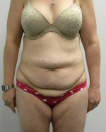 Tummy tuck (Abdominoplasty)