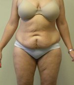Tummy tuck (Abdominoplasty)
