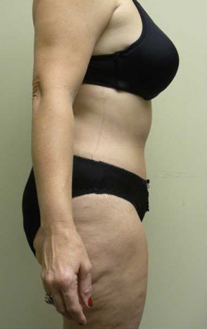 Tummy tuck (Abdominoplasty) Case 4130 After Photo Tummy tuck (Abdominoplasty)