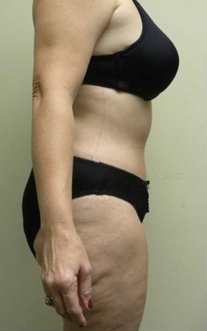 Tummy tuck (Abdominoplasty)