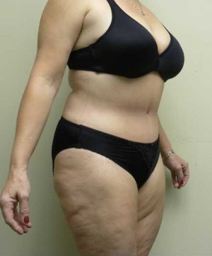 Tummy tuck (Abdominoplasty)