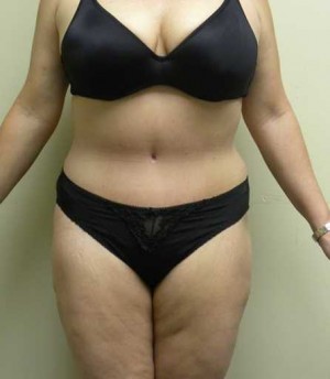 Tummy tuck (Abdominoplasty)