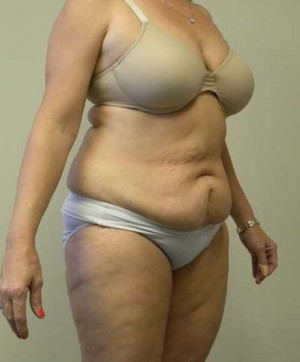 Tummy tuck (Abdominoplasty)