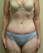 Tummy tuck (Abdominoplasty)