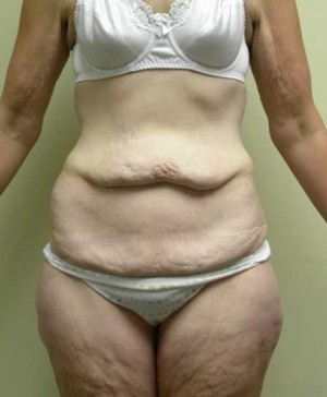 Tummy tuck (Abdominoplasty)