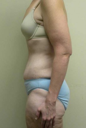 Tummy tuck (Abdominoplasty)