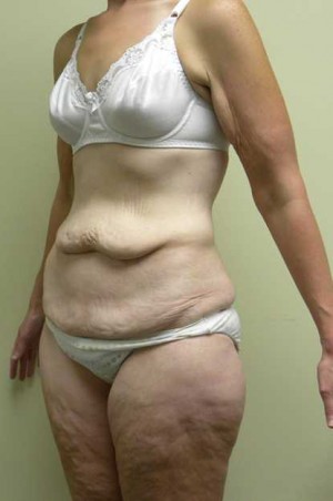 Tummy tuck (Abdominoplasty)