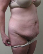Tummy tuck (Abdominoplasty)