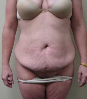 Tummy tuck (Abdominoplasty)