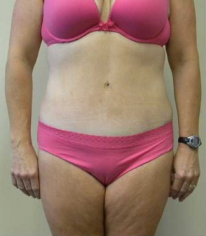 Tummy tuck (Abdominoplasty)