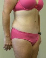 Tummy tuck (Abdominoplasty)