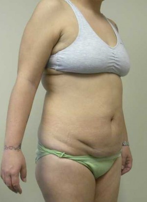 Tummy tuck (Abdominoplasty)