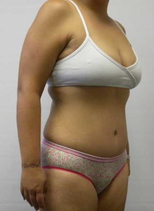 Tummy tuck (Abdominoplasty)