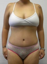 Tummy tuck (Abdominoplasty)