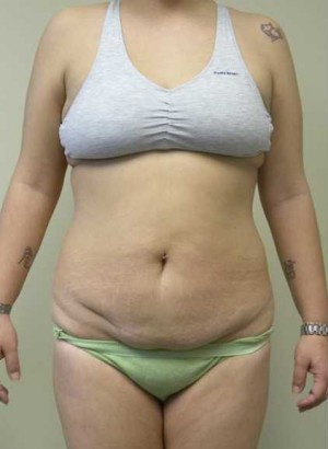 Tummy tuck (Abdominoplasty)