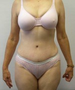 Tummy tuck (Abdominoplasty)
