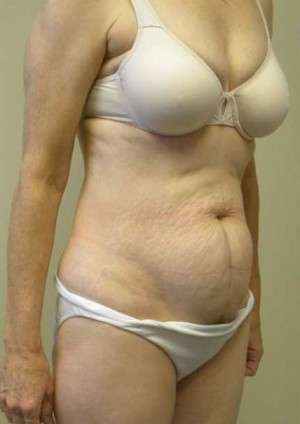 Tummy tuck (Abdominoplasty)