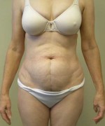 Tummy tuck (Abdominoplasty)
