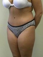 Tummy tuck (Abdominoplasty)