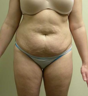 Tummy tuck (Abdominoplasty)