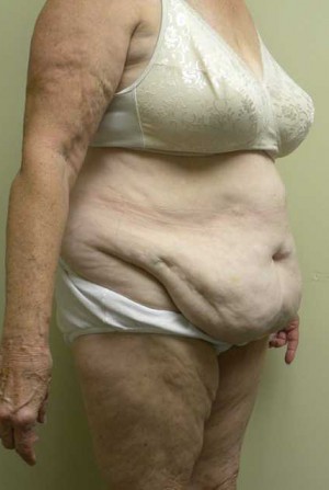 Tummy tuck (Abdominoplasty) Case 4172 Before Photo Tummy tuck (Abdominoplasty)