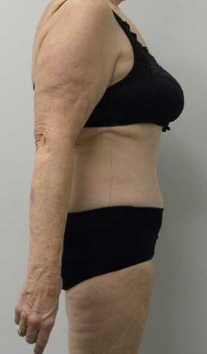 Tummy tuck (Abdominoplasty)